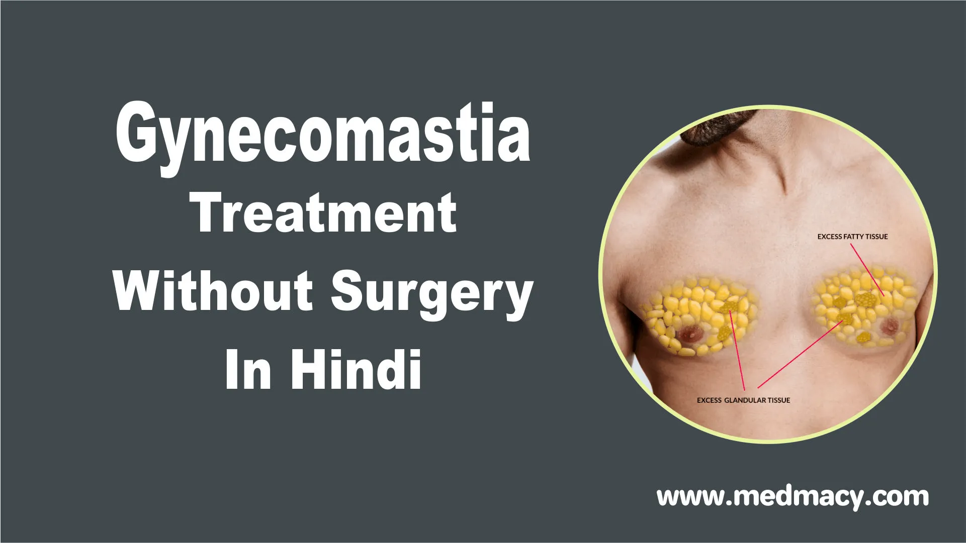 Gynecomastia Treatment Without Surgery
